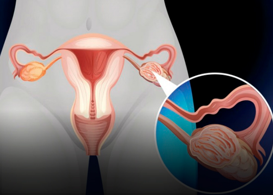 Cáncer de ovario, resta 30 años de vida y podría confundirse con colitis