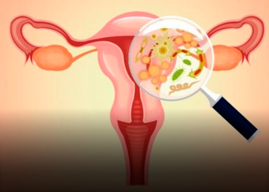 La disbiosis vaginal altera el equilibrio de la microbiota