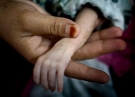 UNICEF alerta de falta de acceso a tratamiento para 12 millones de niños con desnutrición