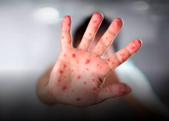Perú emite alerta epidemiológica por "alto riesgo de diseminación" de sarampión en el país